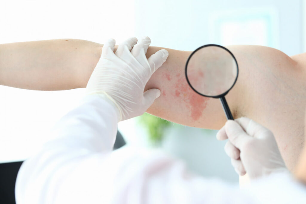 urticarie diagnostic