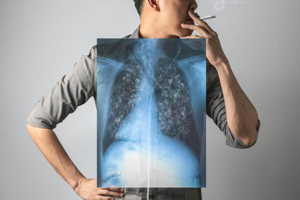 cauze cancer plamani