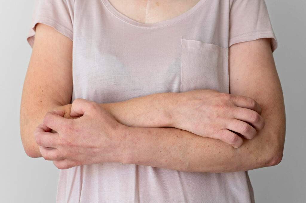 ce este urticaria