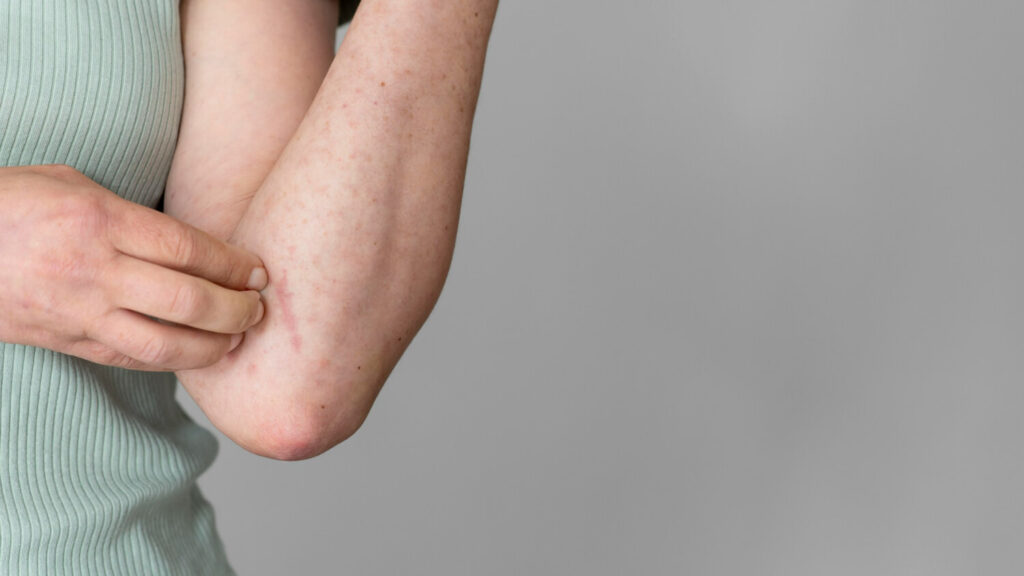 Urticaria vs alte afectiuni ale pielii