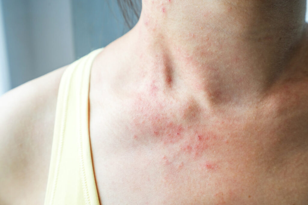 cum poti gestiona urticaria